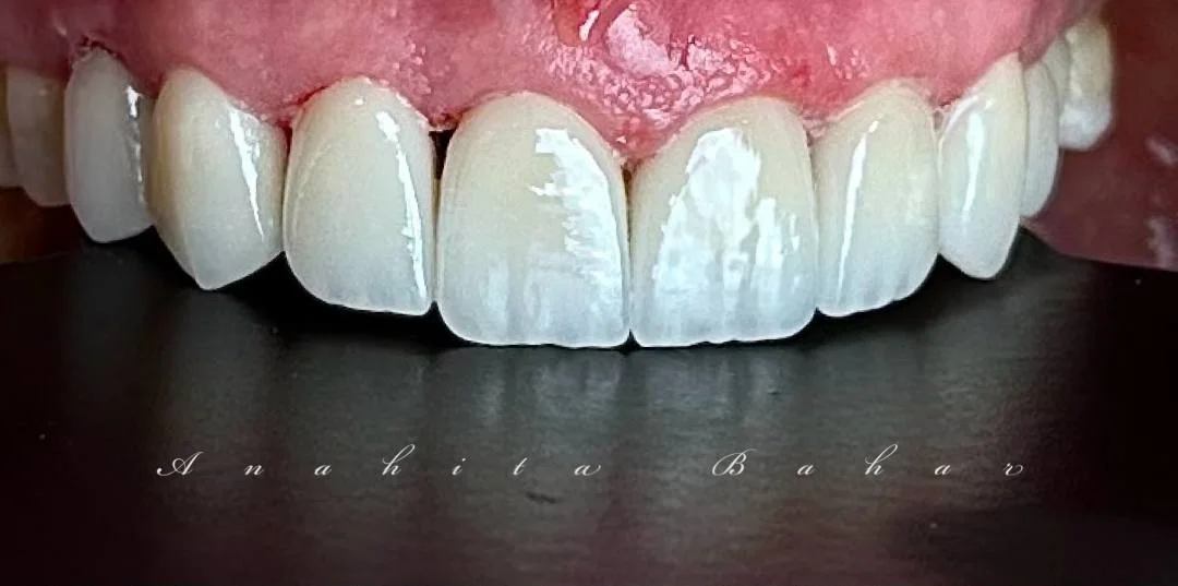 Dental Veneers in Istanbul Dental Veneers in Istanbul Start 4,490TL | Best Quality, Best Price