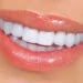 Veneers in Turkey | Best Quality , Best Price | 4,490TL