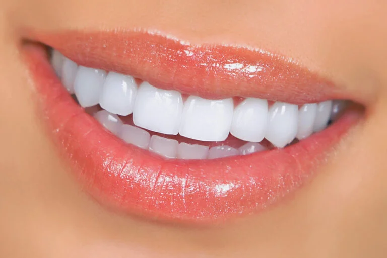 Veneers in Turkey | Best Quality , Best Price | 4,490TL