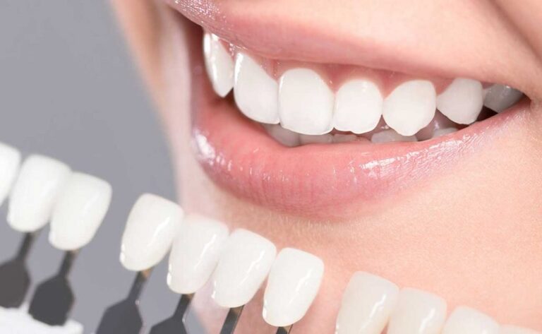 Veneers in Istanbul | 4,490 TL | Ani Dent