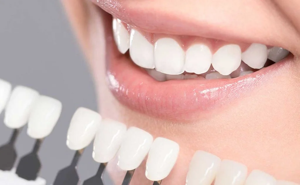 Dental Veneers in Istanbul | Best Quality , Best Price | 4,490TL