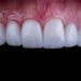 How Much is Dental Veneers in Istanbul? | Price Start from 4,490TL