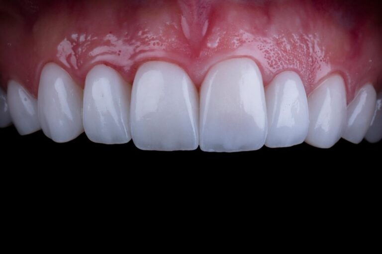 How Much is Dental Veneers in Istanbul? | Price Start from 4,490TL