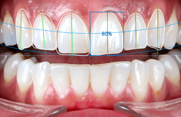 Digital Smile Design in istanbul 2024 | Best Price Best Quality