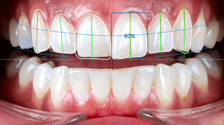 DSD digital smile design in istanbul