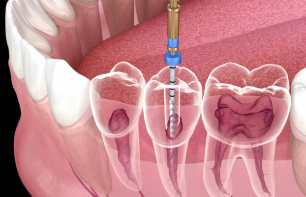 Kök Kanalı Tedavisi 2024: Güncel Yöntemler ve Bilmeniz Gerekenler
