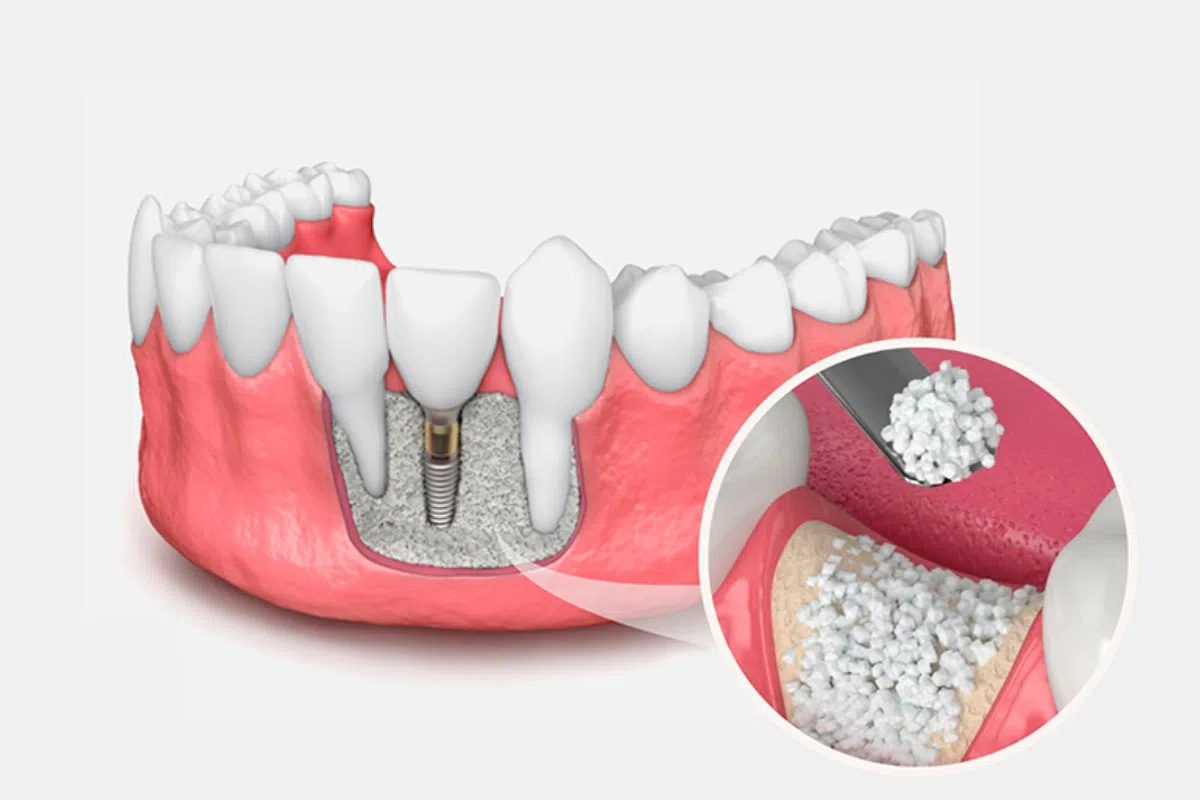 Kemik Grefti Nedir?