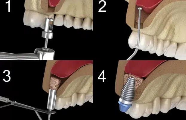 Implant Nasil Yapilir? 2025’te Bilmeniz Gereken Her Şey