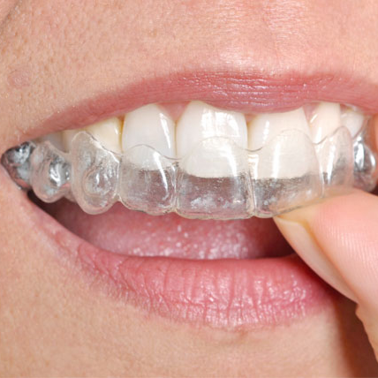 Şeffaf-Plak-Tedavisi